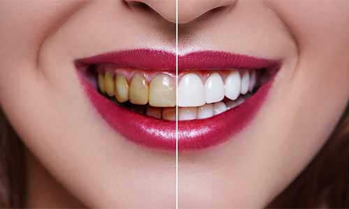 Teeth Scaling, Teeth Whitening services in Keshav Nagar, Mundhwa